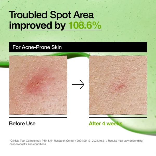 Anua - Azelaic Acid 10 Hyaluron Redness Soothing Serum - 30Ml - Image 6